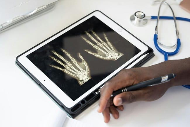 Ilustrasi penyakit rheumatoid arthritis.(Unsplash)